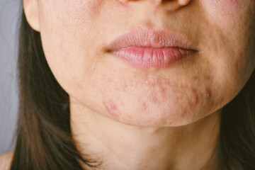 Facial skin problems in women